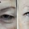 Korekcja powiek (Blepharoplastyka)
