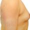 Gynecomastia (Male Breast Reduction)
