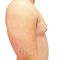 Gynecomastia (Male Breast Reduction)