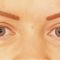 Operácia očných viečok (Blepharoplastika)
