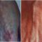 Rimozione tatuaggi - laser