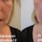 Injections d