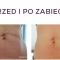 Mezoterapia igłowa - odmładzanie twarzy, szyi, dekoltu, dłoni