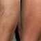 Varicose veins laser treatment