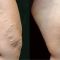 Varicose veins laser treatment
