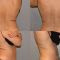 Injection lipolysis
