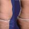 Injection lipolysis