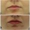 Hyaluronic acid-based wrinkle fillers
