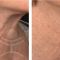 Mesotherapy (face, neck revitalization)