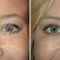 Botulinum toxin - Wrinkle Removal