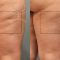 Treatment of cellulite