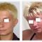 Ear surgery (Otoplasty)