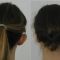 Ear surgery (Otoplasty)