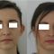 Ear surgery (Otoplasty)