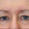 Mikrojehličkování, Microneedling (Skinroller - Dermaroller)