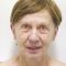 Facelift (operace obličeje), SMAS lifting