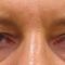 Korekcja powiek (Blepharoplastyka)