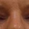 Korekcja powiek (Blepharoplastyka)