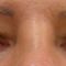 Korekcja powiek (Blepharoplastyka)