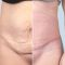 Abdominoplastika (Operace břicha)