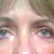 Eyelid surgery (Blepharoplasty)