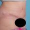 Abdominoplastika (Operace břicha)