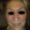 Korekcja powiek (Blepharoplastyka)