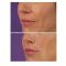 Hyaluronic acid-based wrinkle fillers