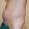 Abdominoplastyka (operacja powłok brzucha)