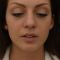 Lip augmentation - cheiloplasty