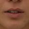 Lip augmentation - cheiloplasty