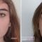 Rhinoplastie