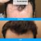 Hair Transplant