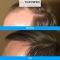 Hair Transplant