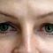 Korekcja powiek (Blepharoplastyka)