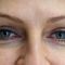 Korekcja powiek (Blepharoplastyka)