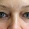 Korekcja powiek (Blepharoplastyka)
