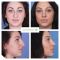 Rhinoplastie