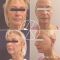 Facelift (operace obličeje), SMAS lifting