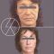 Facelift (operace obličeje), SMAS lifting