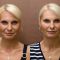 Hyaluronic acid-based wrinkle fillers