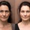 Hyaluronic acid-based wrinkle fillers