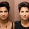 Hyaluronic acid-based wrinkle fillers