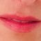 Teosyal, Restylane, Esthelis, Juverdem, Surgiderm (preparáty kyseliny hyaluronovej)