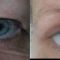 Operácia očných viečok (Blepharoplastika)
