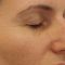 Operácia nosa (Rhinoplastika)