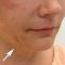 Facelift, SMAS facelifting