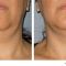 Non Surgical Lift