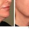 Non Surgical Lift
