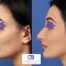 Rinoplastie